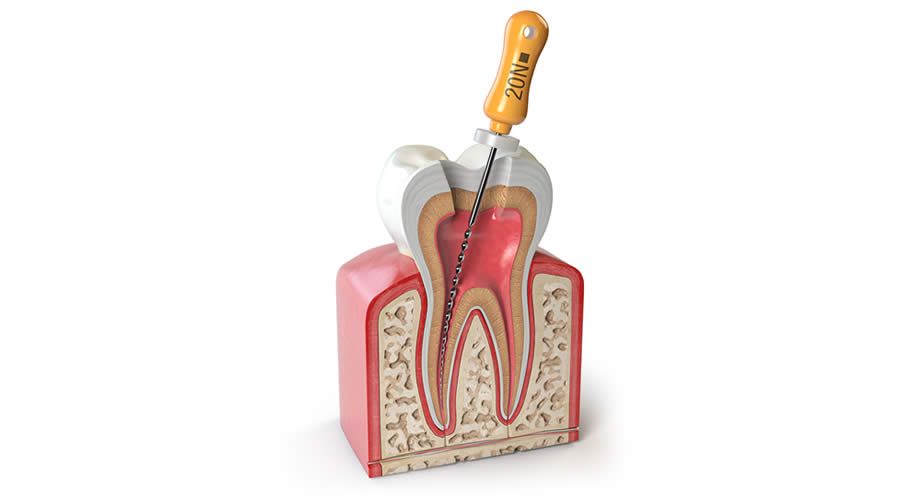 Endodonti nedir