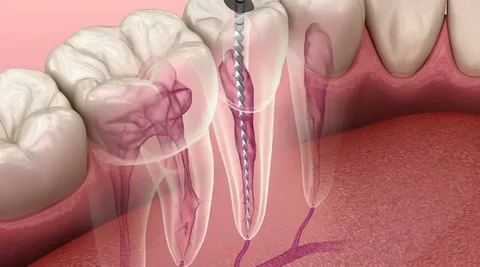 Endodontik tedavi aşamaları