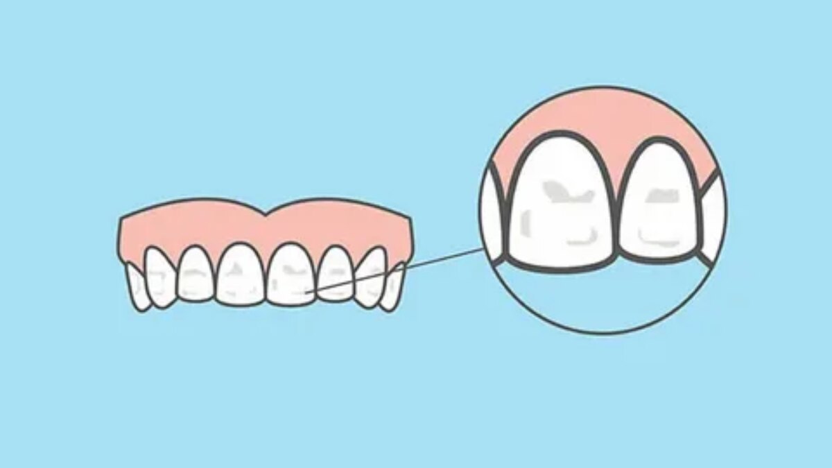 diş sızlaması nasıl geçer evde